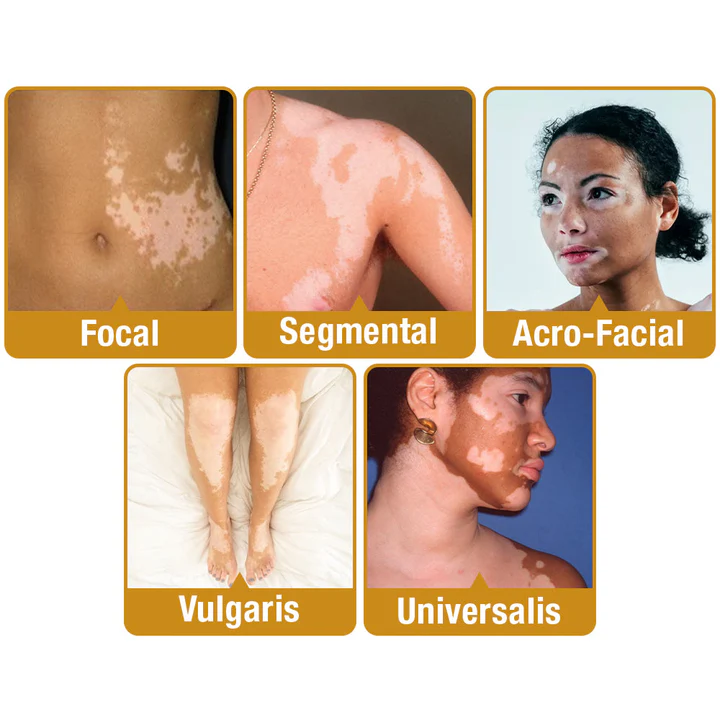 Oveallgo™ BeeVenom Vitiligo Treatment Cream
