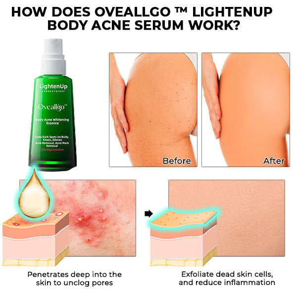 Oveallgo™ LightenUp Body Acne Serum (for Acne & Spots & Acanthosis Nigricans Removal)